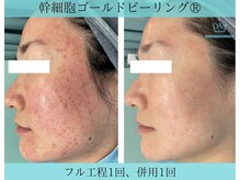 リメイククリニカルビューティー(Remake clinical beauty)/赤みも改善可能！