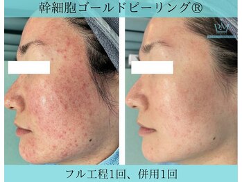 リメイククリニカルビューティー(Remake clinical beauty)/赤みも改善可能!