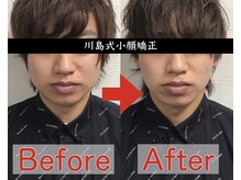 アベックトア(Avectoi)/男性にもオススメな小顔矯正