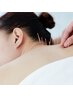 【女性特有のお悩み｜身体・首肩のお悩みにも】鍼灸施術 120分 ¥11000→¥7700