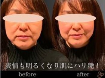 チョコバリ 郡山店(chocobari)/小顔×リフトアップ(美容鍼)40代