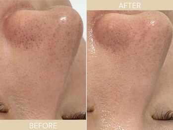 エクラ(eclat)/施術回数:1回