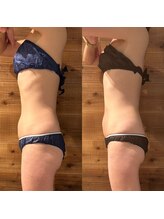 サラモ(Sa La Mo)/脂肪冷却　お腹　太もも