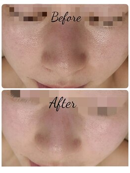 サロン ド ハニー(Salon de Honey)/美肌効果!ララピール×プラズマ