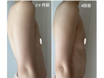 美バストアルファ(美bust α)/【光豊胸】症例