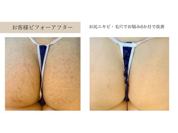 エミルカ 北谷店(EMILUCA)/ハーブピーリング美尻へ変化