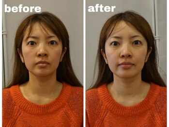 噂のほぐし屋 コリトル整体院/1回の小顔施術で効果あり!