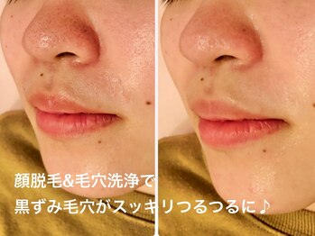 ディオーネ 新潟けやき通り店(Dione)/顔脱毛と毛穴洗浄