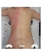 アーネラミーナ(Anela mina)/施術例