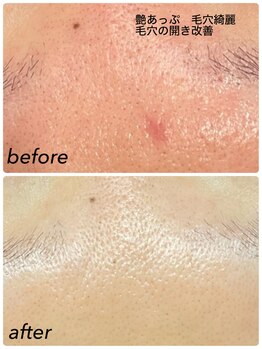 ニコリ(Nicori)/ハーブピーリング