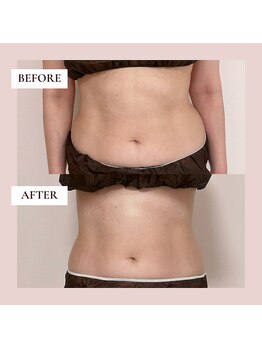 ミーティス/お腹のたるみを集中ケア♪