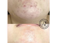 エクセレントビューティーサロン 艶(EN)の雰囲気（【肌管理】ニキビ・シミ・くすみアクア&医療ハーブピーリング）