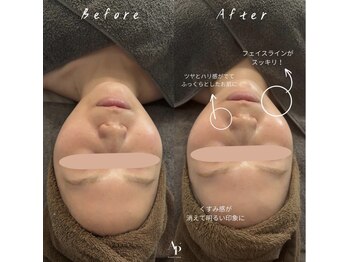 アピュルテ(A purete')の写真/【陶器肌へ導く】肌質改善は当店にお任せ◎ハーブピーリングで毛穴・ニキビ・シミ・しわを集中ケア！
