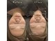 アピュルテ(A purete')の写真/【陶器肌へ導く】肌質改善は当店にお任せ◎ハーブピーリングで毛穴・ニキビ・シミ・しわを集中ケア！