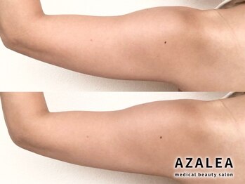 アザレア(Azalea)/二の腕スタンプ&サーマリフト