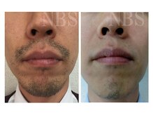 ラディアアンドココサロン(Radia&Coco_salon)/ヒゲ脱毛ビフォーアフター☆