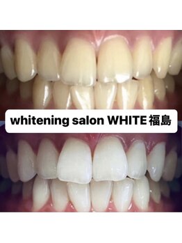 ホワイトニングサロン ホワイト(WHITE)/セルフホワイトニング効果