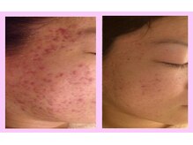 ハリス(HARIS)/長年の悩みの種、肌荒れ改善