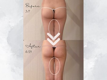 サイバーエステ 宇都宮店/1カ月で太もものスキマ爆誕！