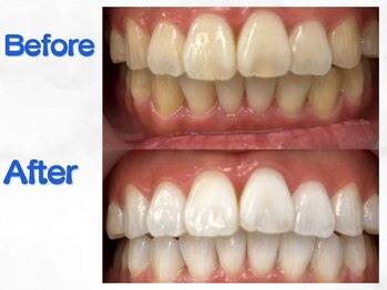 LBSホワイトニング 梅田店/ホワイトニングビフォーアフター