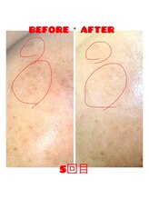 脱毛 痩身ぴゅあら/しみケア5回