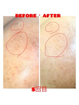 脱毛 痩身ぴゅあら/しみケア5回