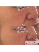 ラトワ(LATOWA)/棘なし　ハーブトリートメント