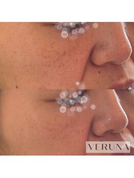 ラトワ(LATOWA)/棘なし ハーブトリートメント