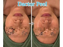 ネオズエゴ アーチ(neos ego Archi)/ダクトピール　ビフォーアフター