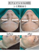 アースコアフュールボーテ ひたち野うしく店(EARTH coiffure beaute)/シミ照射4回目「IPL光フォト」