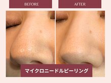 セレブヒルズ 札幌本店(Celeb Hill's)/マイクロピーリング1回目