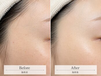 シークパナッシュ(Chic panache)の写真/アイブロウで目元の印象を変える。糸脱毛による全顔脱毛でツヤツヤゆで卵肌な夏を過ごす◎