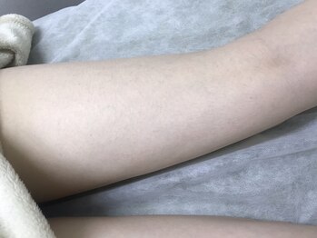 ナノハナ/鹿沼市本格全身脱毛ナノハナ