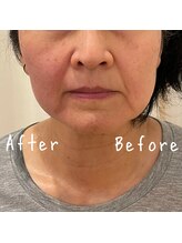 メガミノチカラ/【セルフ】フェイシャルマシン