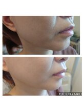 サロンドエステ ルヴニール(salon de esthe revenir)/1回で体感♪