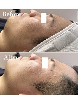 ホワイトワックス 京都四条烏丸(WHITE WAX)/《全顔》フェイシャルワックス