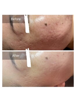 ヒール(heal)/毛穴からーっぽコース