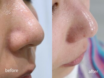 マイ フェア レディ(MY FAIR LADY)/毛穴・黒ずみ改善