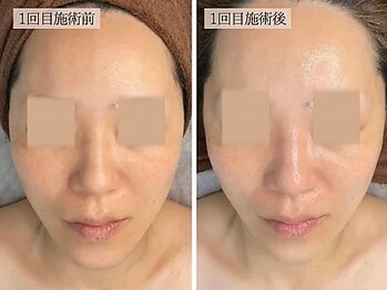 リノン(LINON)/ハーブピーリング