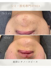 アトリア(ATRIA)/純粋レチノールピール