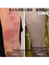 リレフー(Relafy)/皮膚でお悩みの方