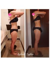 グレイスボディ BiViつくば店(Grace Body)/ボディ＋超音波機器症例写真