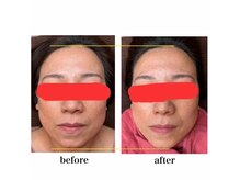 美プラス/《40代》小顔矯正