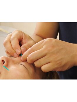 鍼灸施術を受けたい