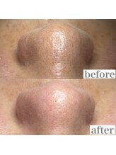 ライカブルー(RaicA BluE)/施術写真　before-after