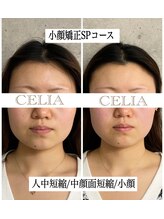 セリア(CELIA)/ビフォーアフター