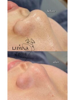 ルミナエステ(LUMINA ESTH)/毛穴/毛穴洗浄/毛穴ケア|症例