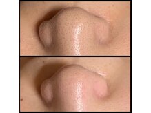 毛穴汚れに特化した「潤い素肌・毛穴美人コース」も人気です！