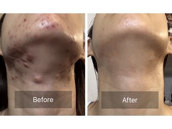 ヴィクトリアサロン(VICTORIA SALON)/ニキビケア