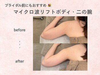 クレスト(CLEST.)/マイクロ波ボディbefore/after